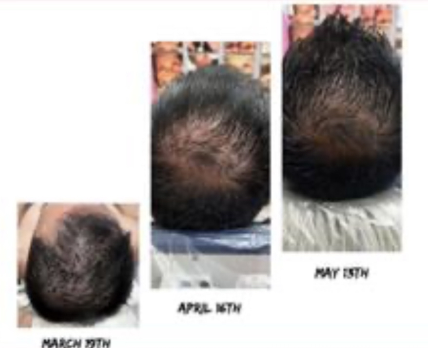 Hair RE growth entire head~ Procell Micro-Channeling