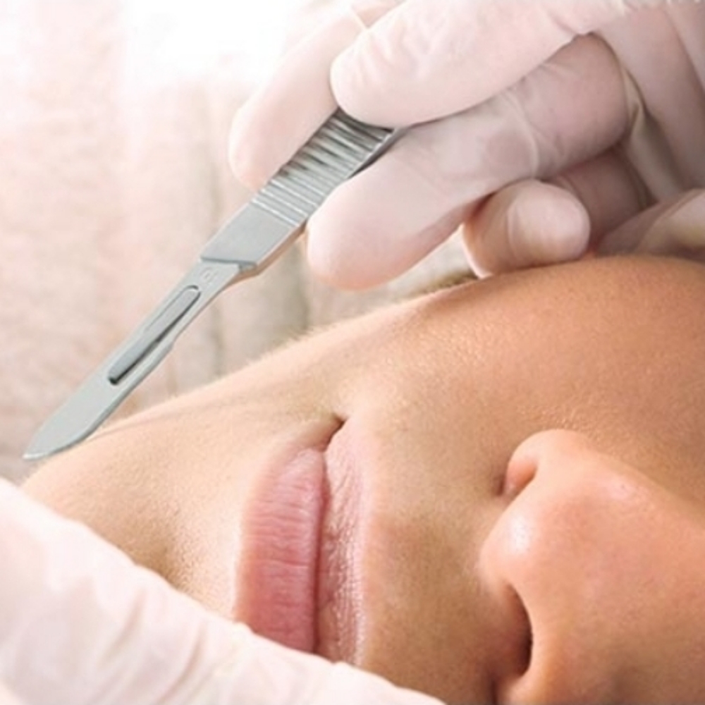 DERMAPLANING FACIAL at Surf City Skincare in St. Johns, FL
