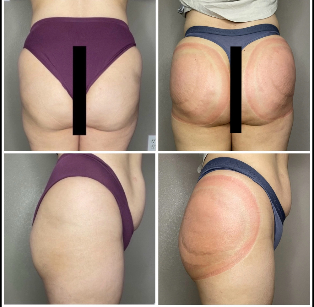 Booty Lift at Sculpted by Lluvia in Weslaco, TX