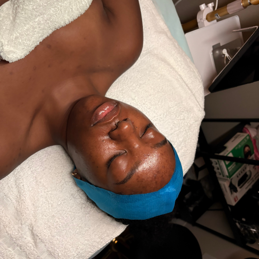 Acne Clarifying Chemical Peel at PR Beauty Bar in Conway, AR
