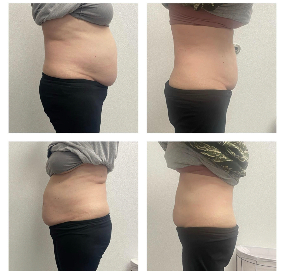 💥💥💥PROMO (Body Contouring)