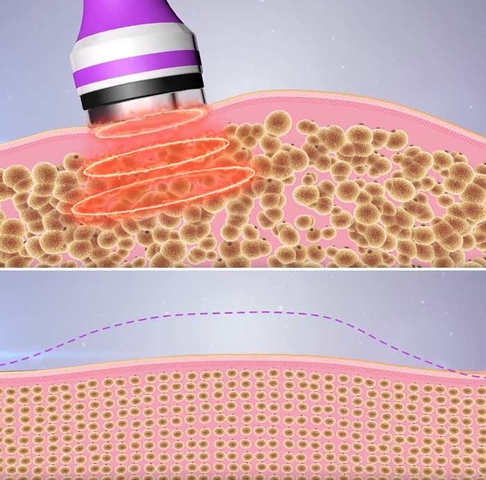 Ultrasonic Cavitation & RF