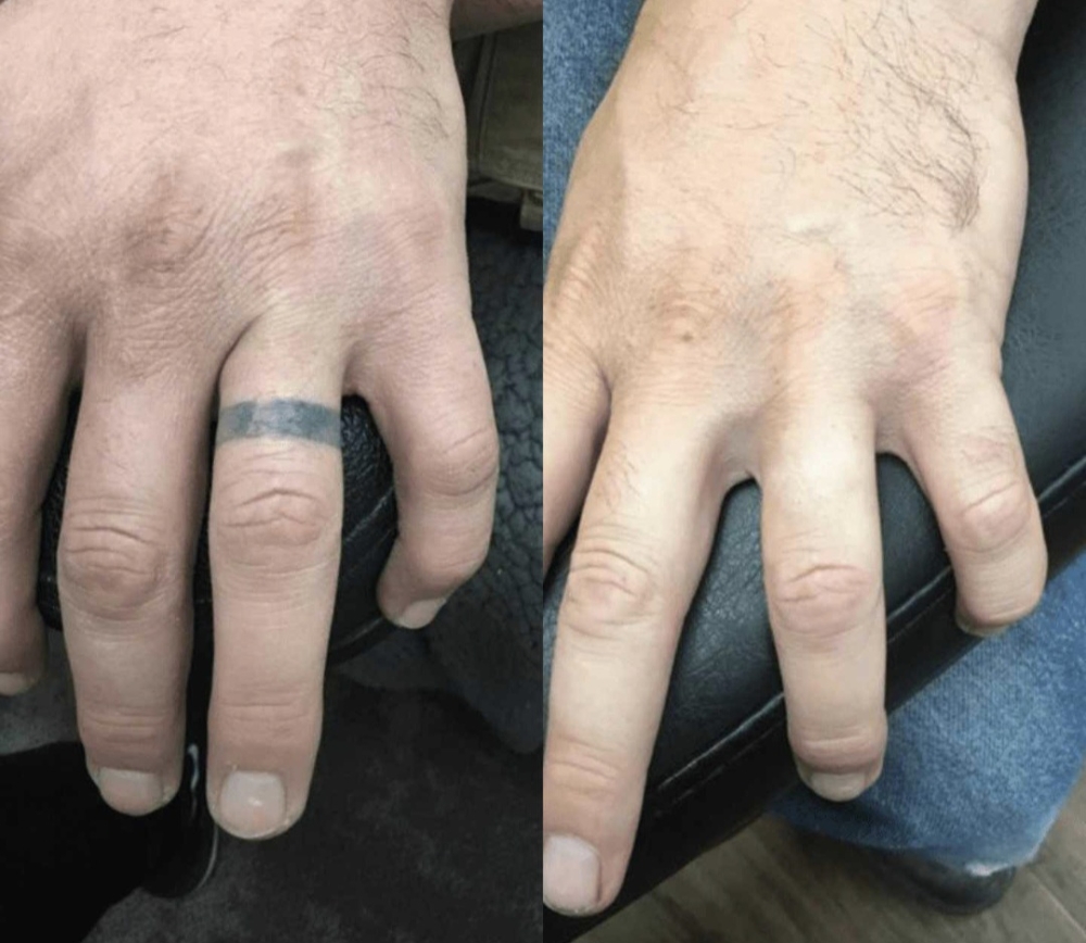 Remoción de Tatuajes