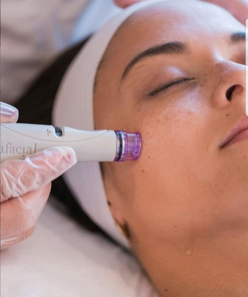 Microdermabrasion Facial