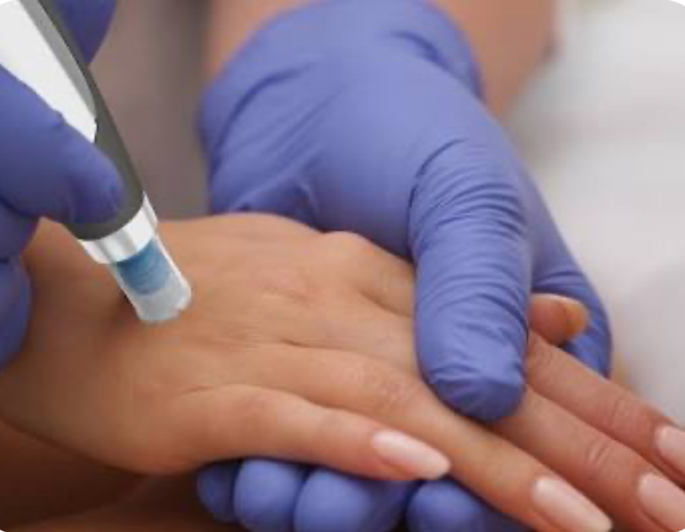 Exosome Microneedling Arms & Hands
