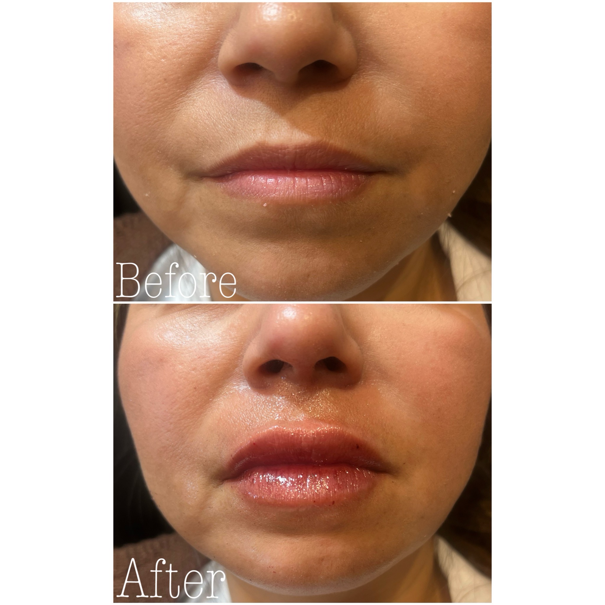 Dermal Fillers