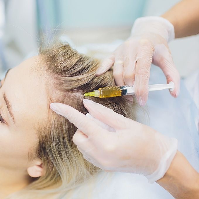 PRP Scalp/Hair Restoration