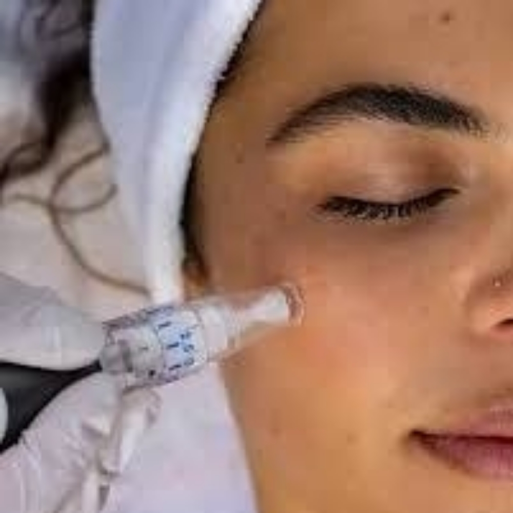 Flash Sale Microneedling at Be Beautiful Esthetics in Cleburne, TX
