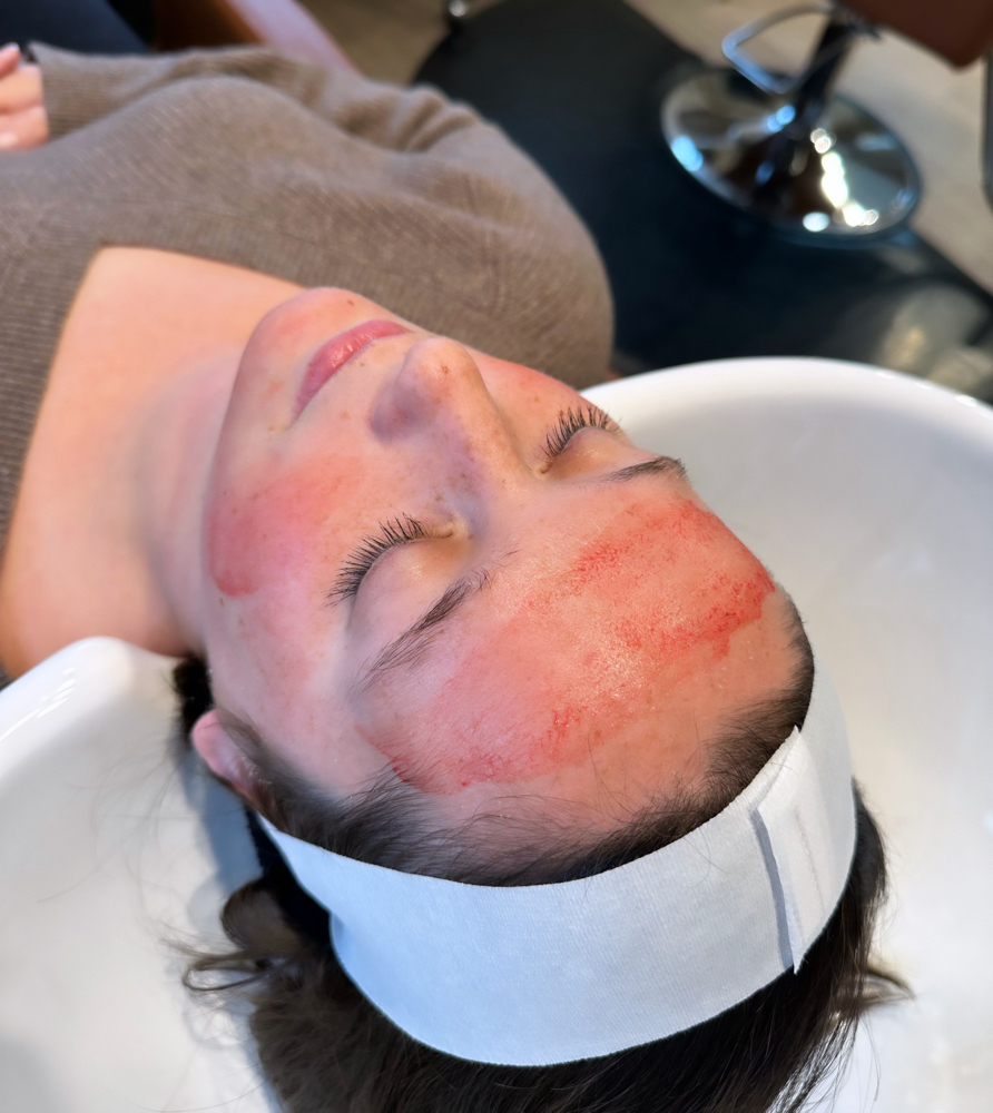 PRP Facial