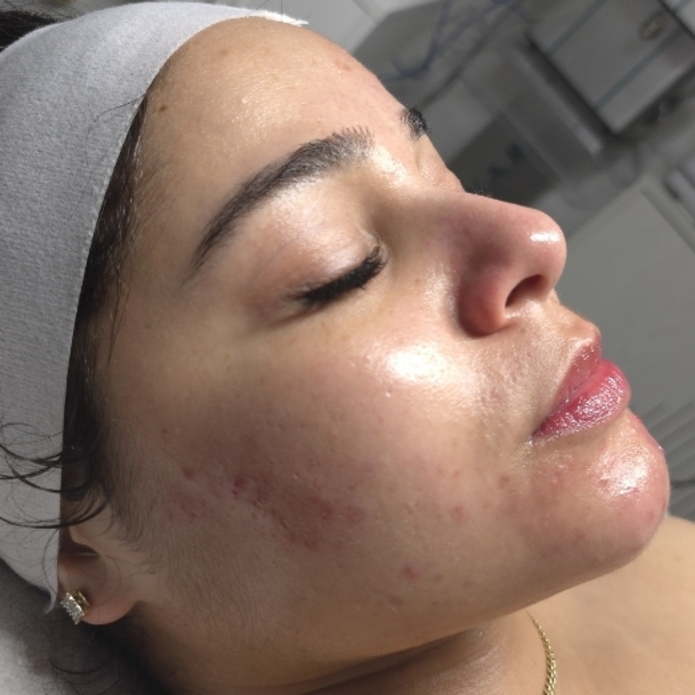 A1 Hydrating Enzyme Facial at Stephs A1 Beauty Bar in Southwest Ranches, FL