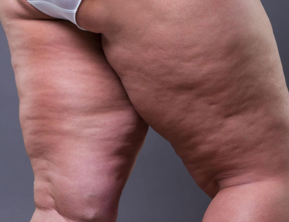 Anti- Cellulite Massage