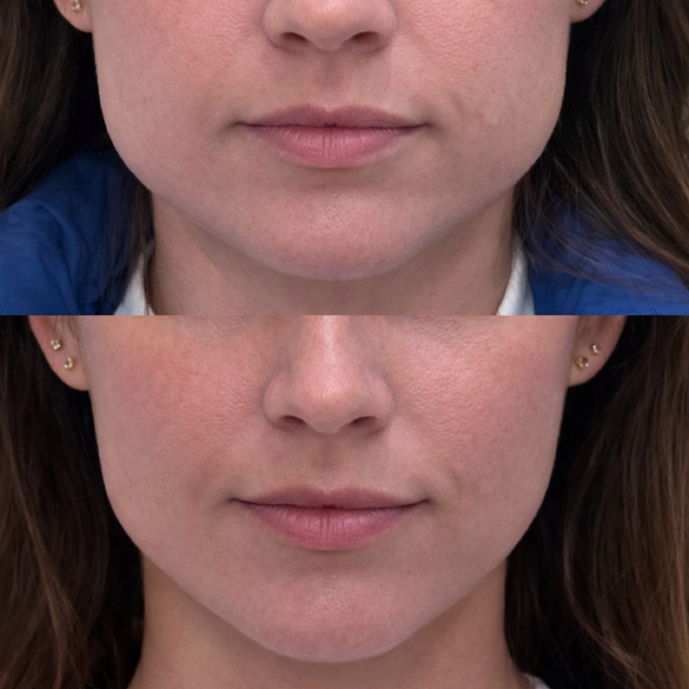 Botox- Masseter/TMJ at Groomsology MedSpa in Mt Orab, OH
