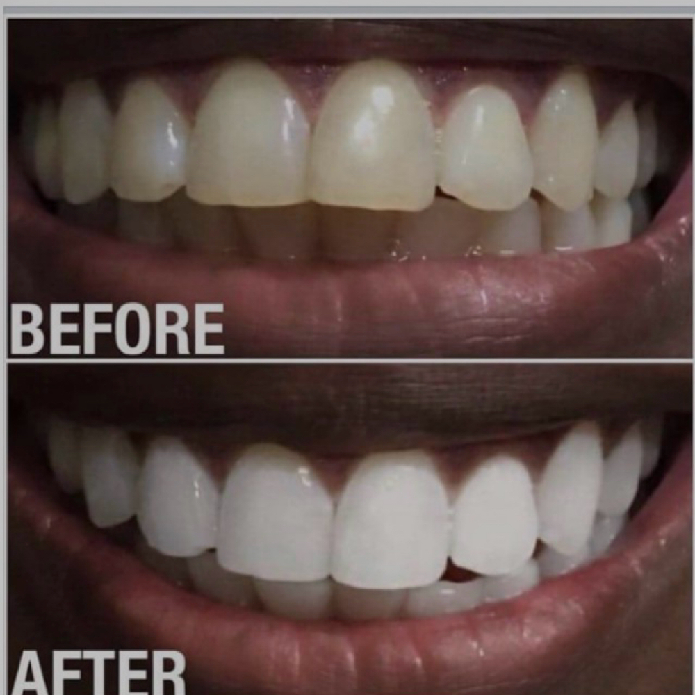 The Allure Glow at Allure Teeth Whitening in Greensboro, NC