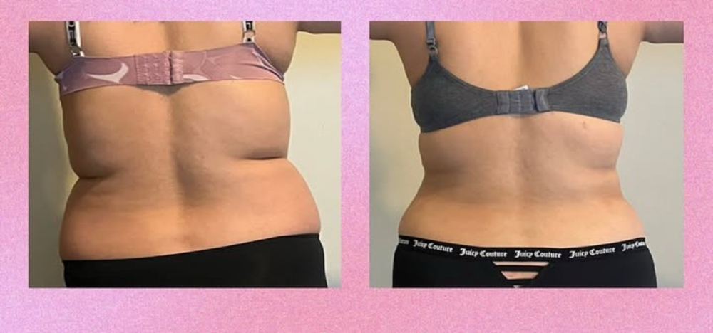 2 Sessions | Fat Dissolving