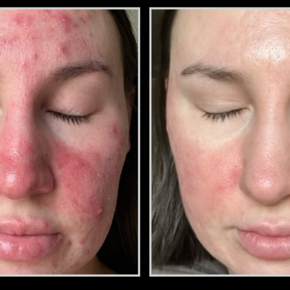 ADVANCED CORRECTIVE SKINCARE at Lashes+corrective skincare+waxing+brows in Temecula, CA