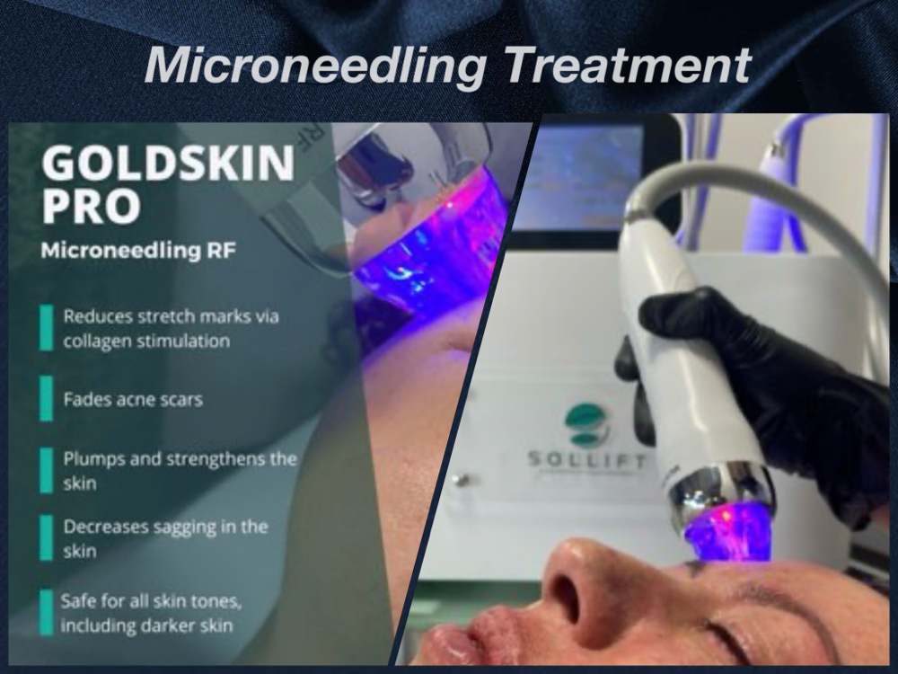 Microneedling