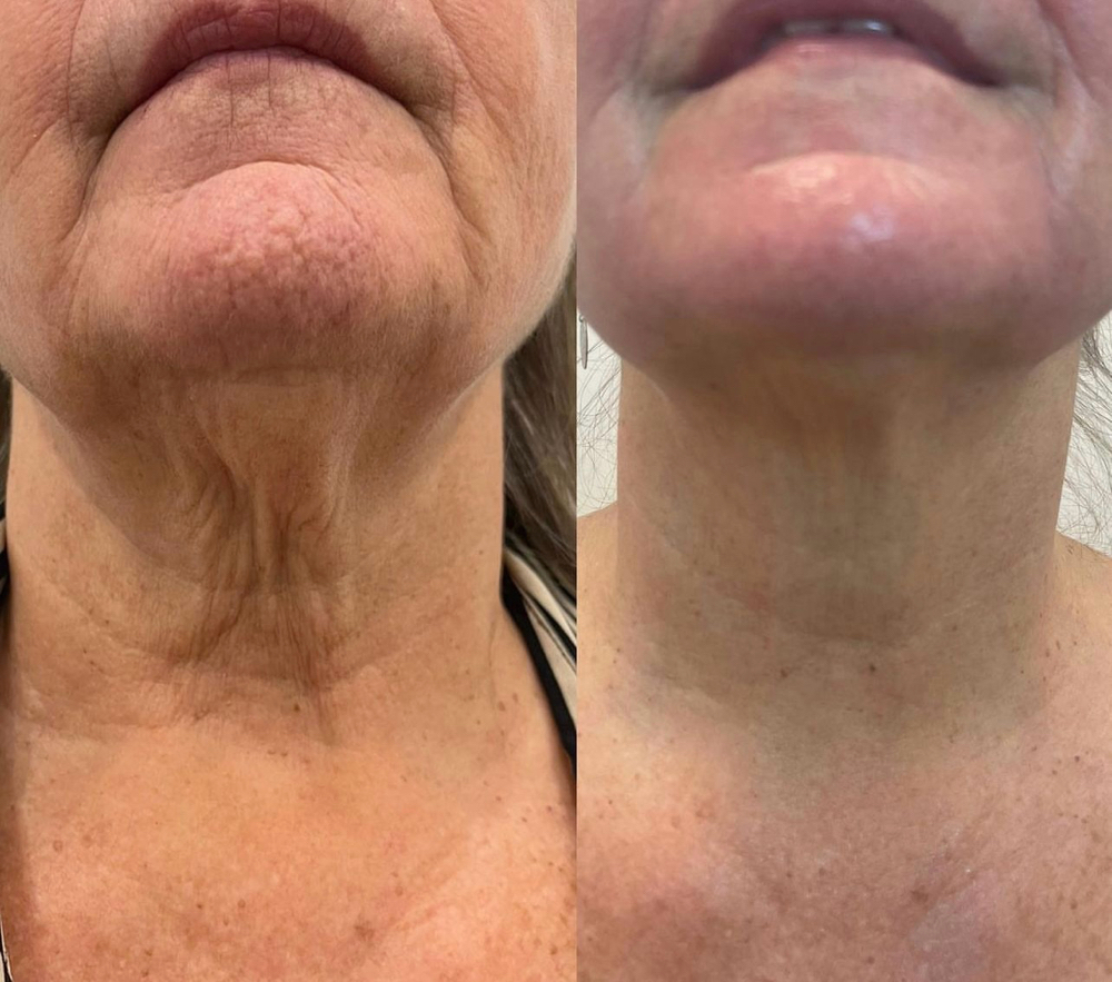 Full Neck Fibroblasting Treatment