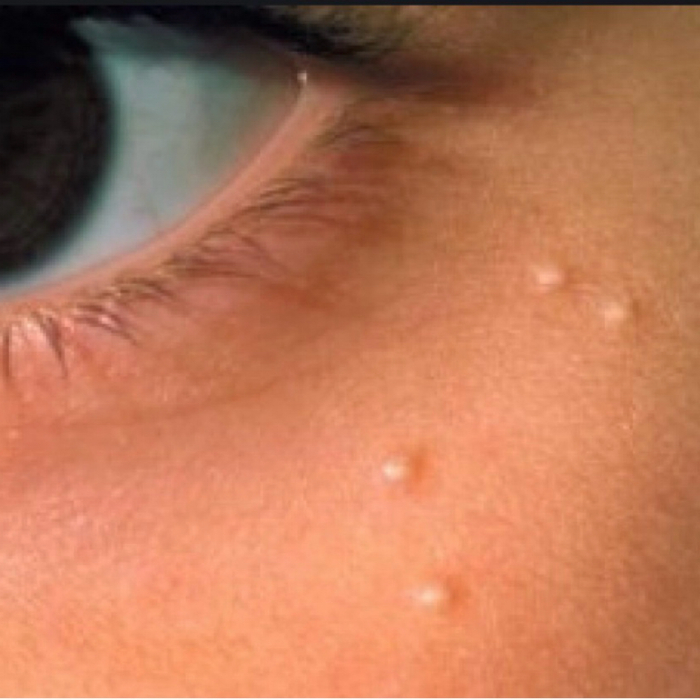 Milia Removal at Sanazskincenter in Vienna, VA