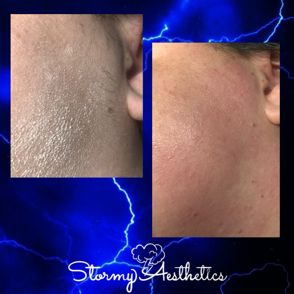 Sideburn Wax at Stormy Aesthetics in Clearwater, FL