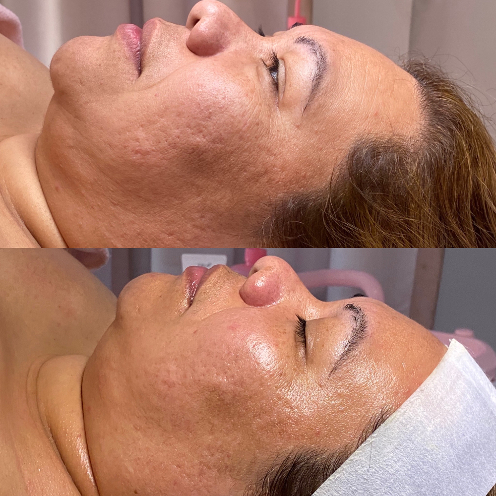 Anti-Aging Facial