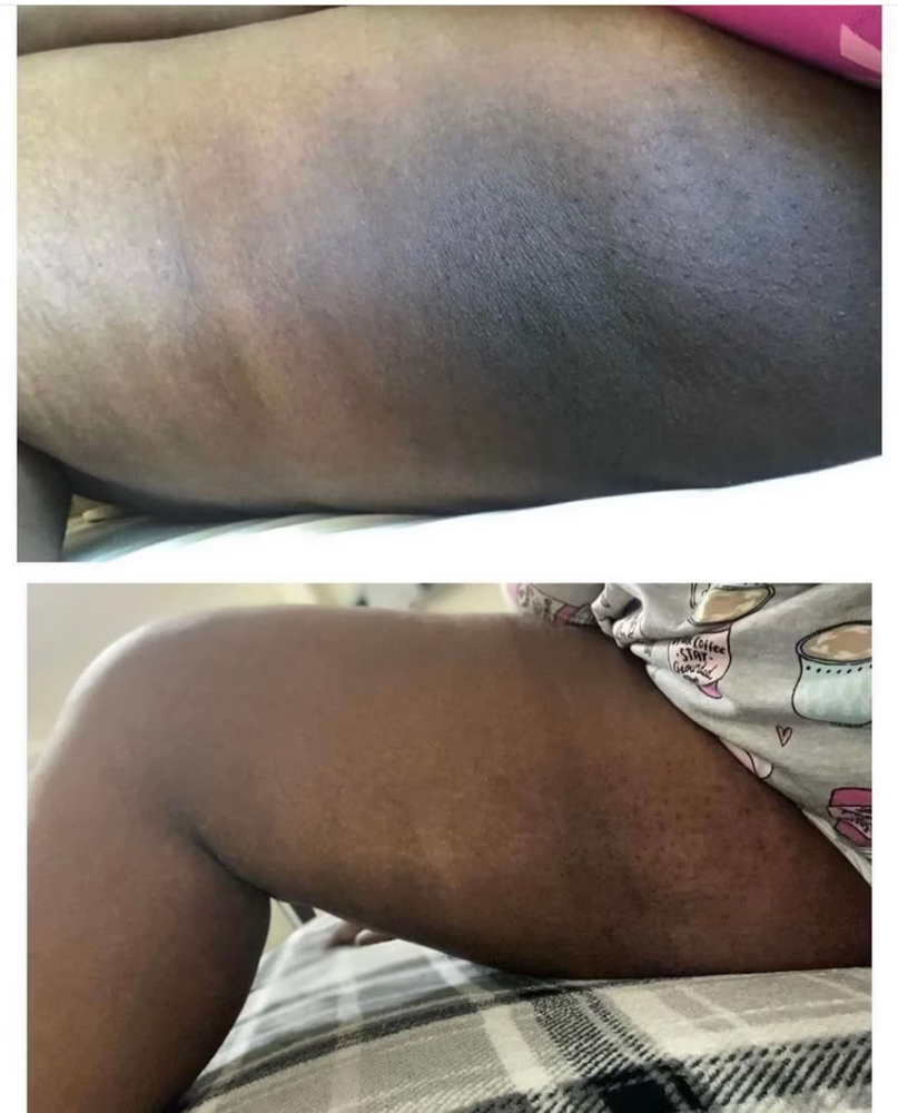 Lighten The Inner Thigh Facial