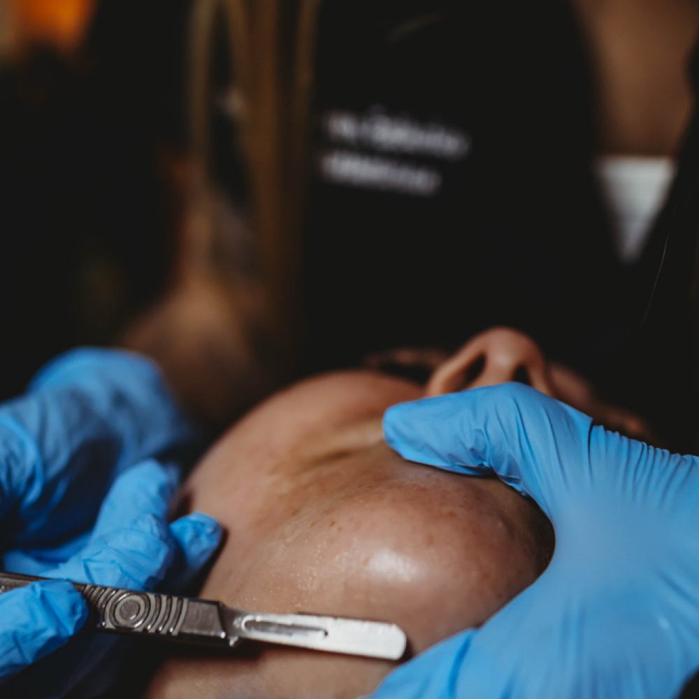 Nano Infusion & Dermaplane Facial at Her Esthetics in Olean, NY