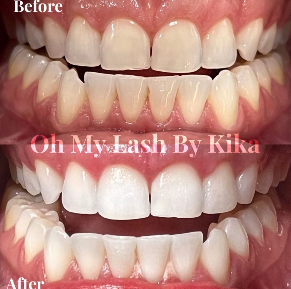 60 MINS TEETH WHITENING