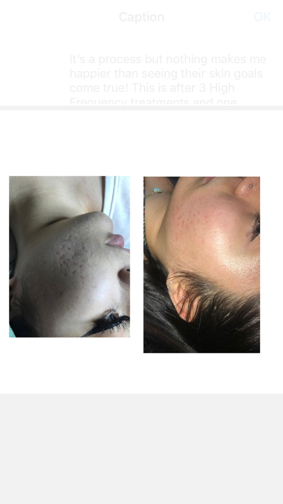 Microneedling facial