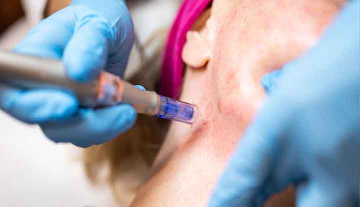 Microneedling Add-on Of Neck Area