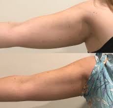 ARM FAT ~ Under Arms