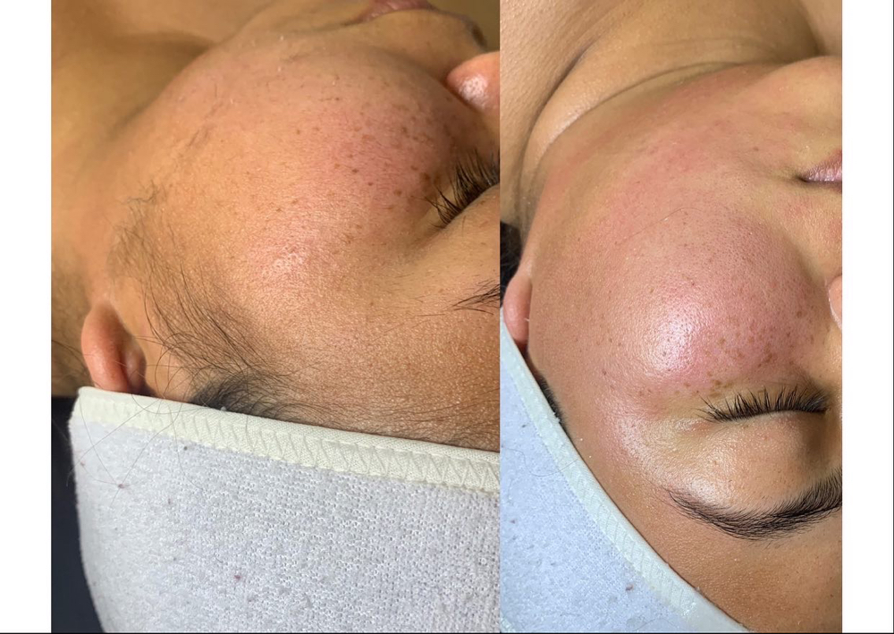 Dermaplaning Glow Facial