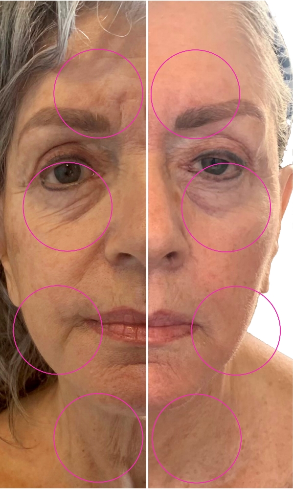 Cryo Facial Treatment