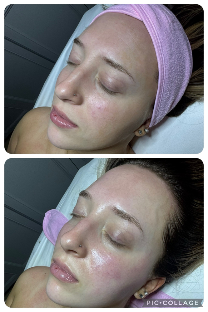 Dermaplaning Facial