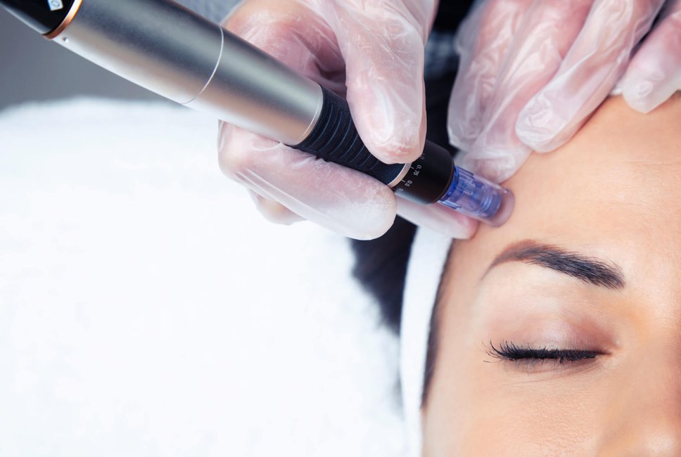 MicroNeedling