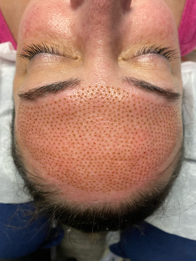 Fibroblast Treatment Forehead