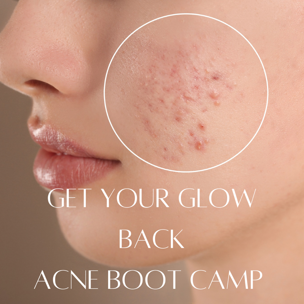 Acne Program Consultation