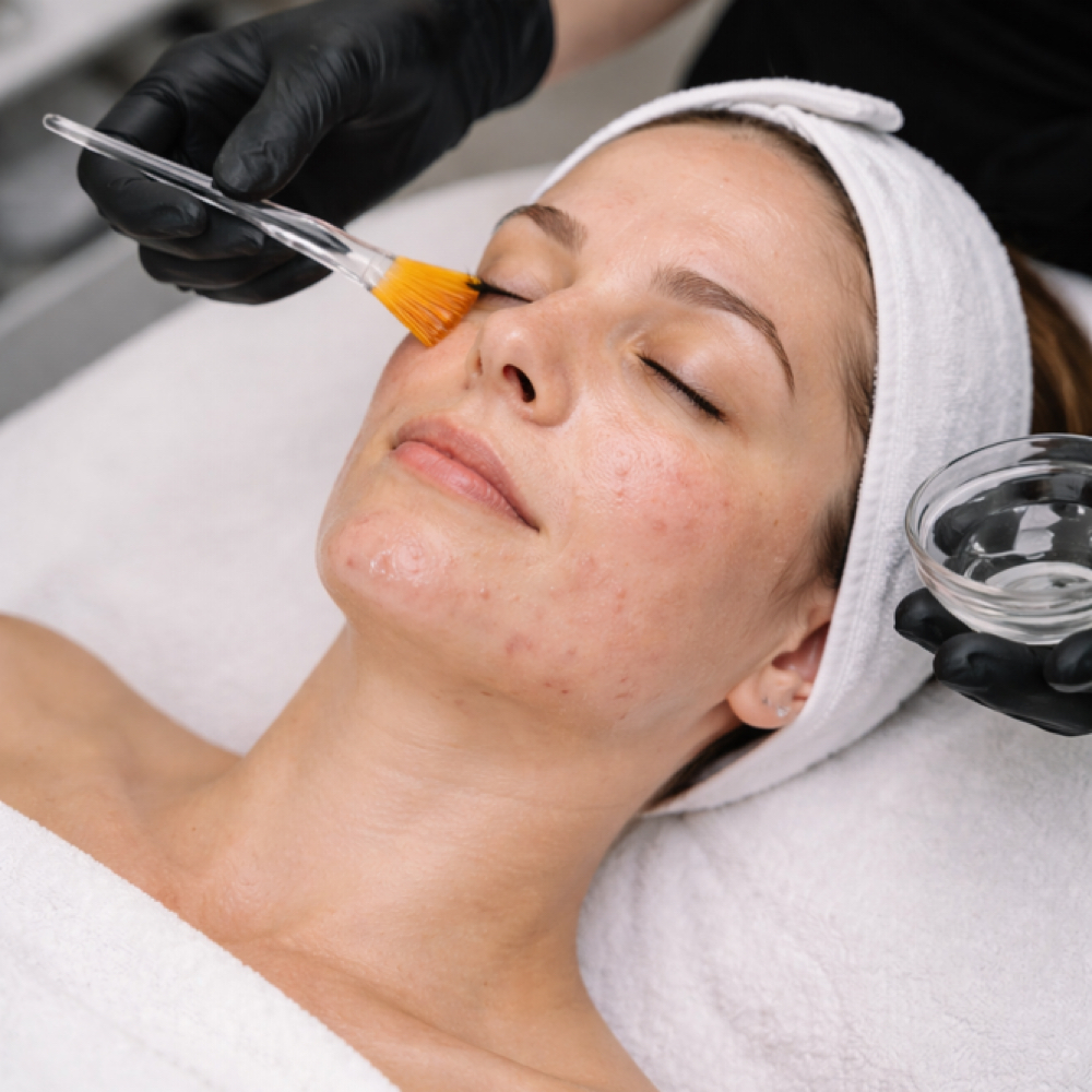 Acne Bootcamp Peel at Poised Aesthetics in Scottsdale, AZ