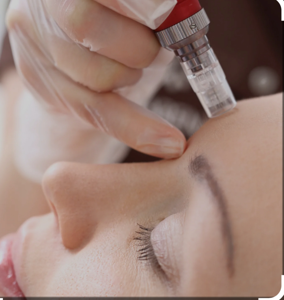 Microneedling