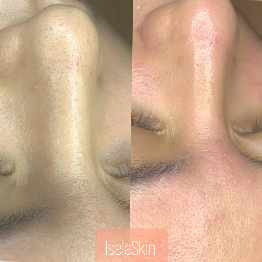 Teen Facial