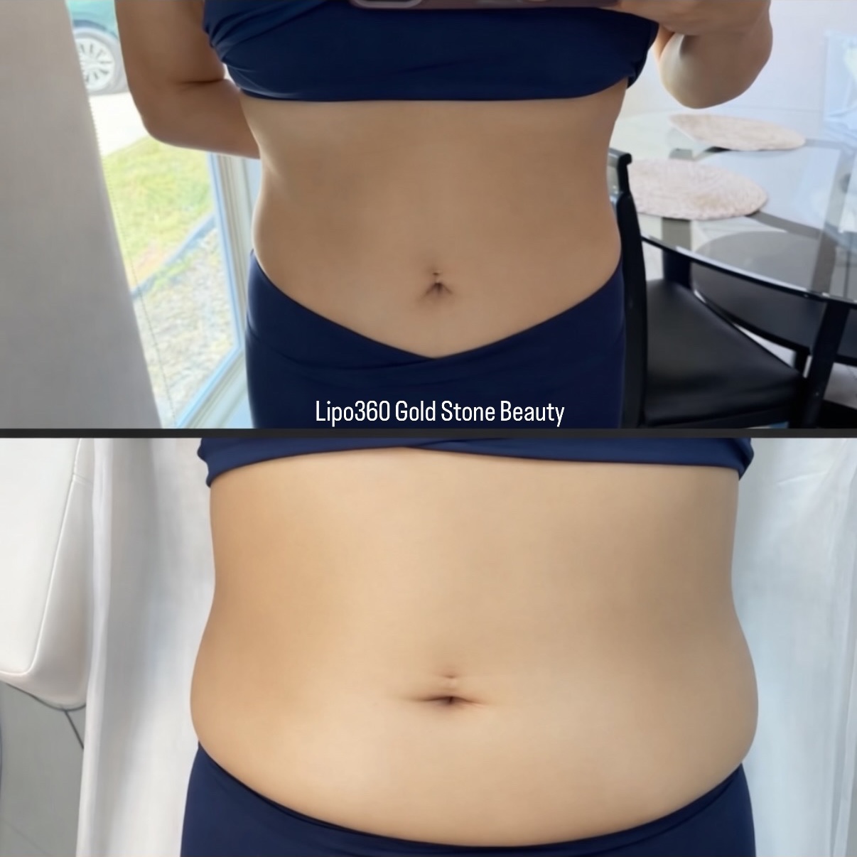 Lipo 360 Tummy at Gold Stone Beauty in mcallen, TX