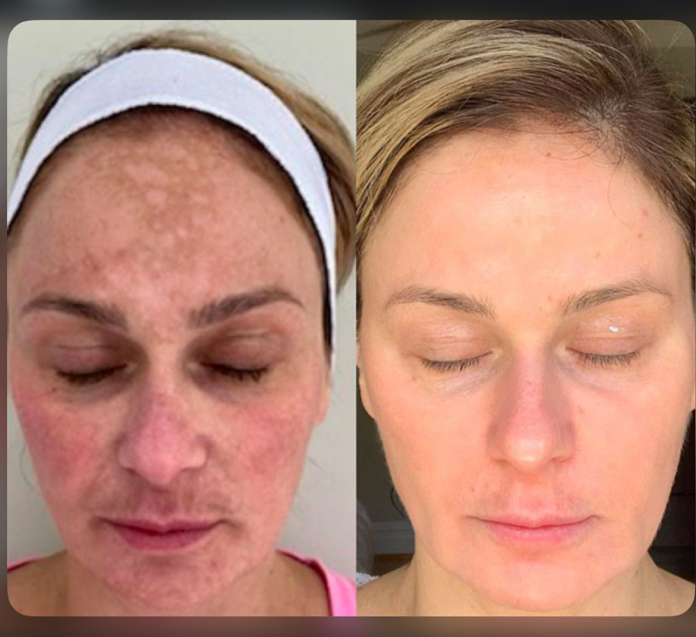 COSMELAN Peel For Melasma