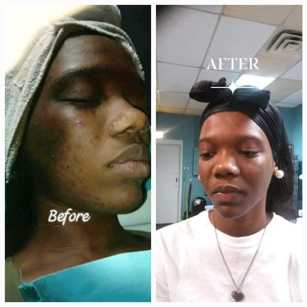 💥 Acne Treatment at JUST BEAUTIFUL SKIN in Goose Creek, SC
