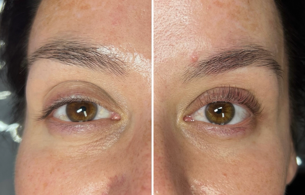 Lash Lift