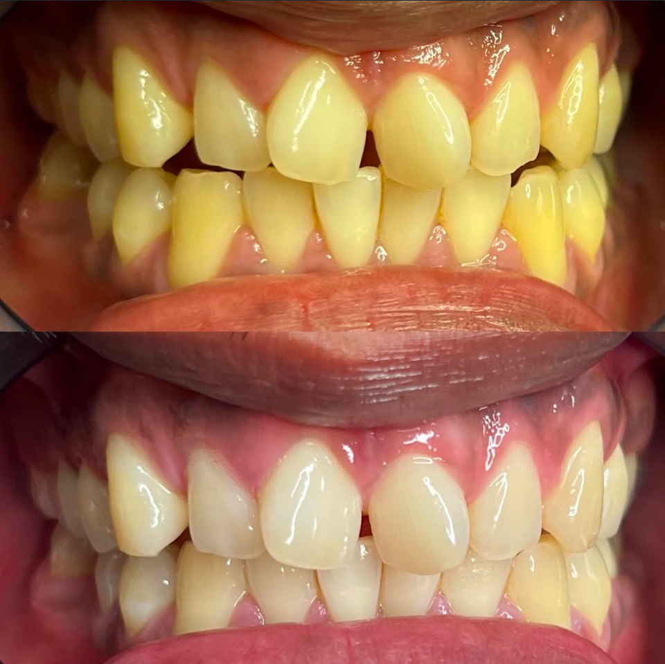 Teeth Whitening 80 Min