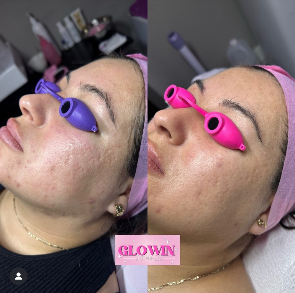 BioRePeel (single treatment)