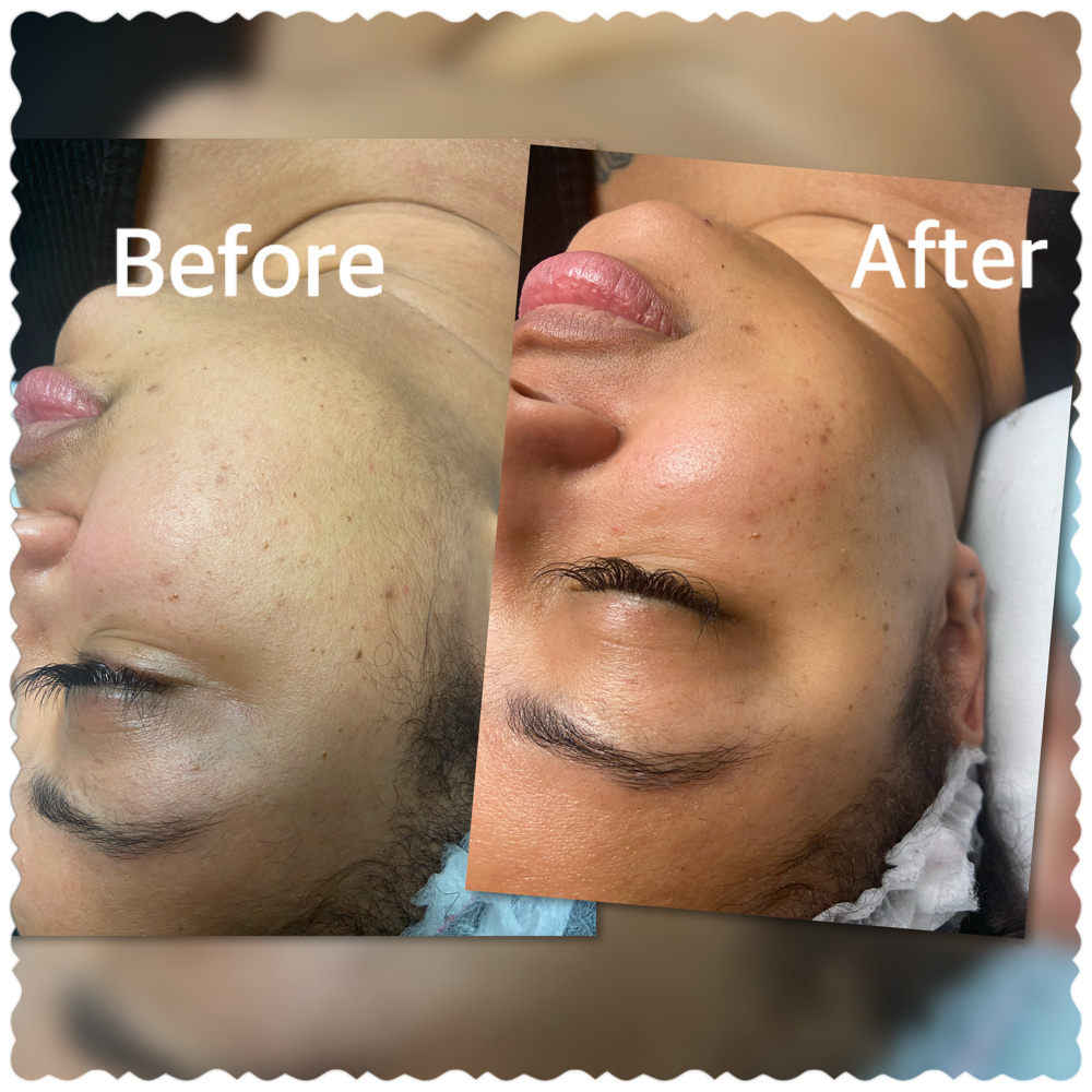 Dermaplane Glow