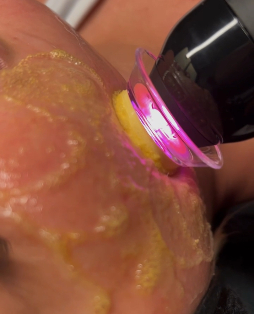 Glo2Facial Mini at SKN Med Spa in Delray Beach, FL