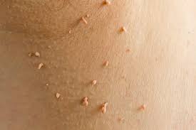 Skin Tag removal 10+