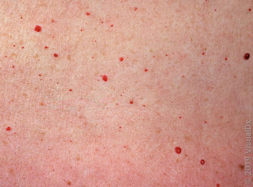 Ruby point treatment 20 mins