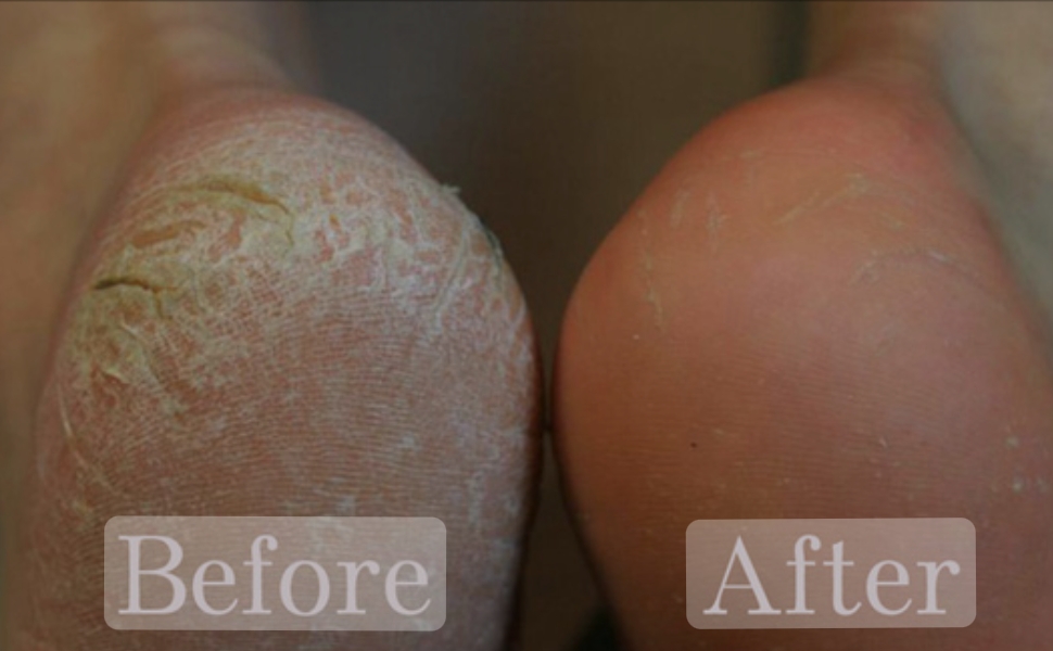 Callus treatment